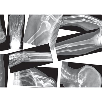 Radiographies des os brisés
