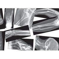  Broken Bones X-Rays